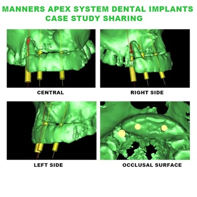 Manners Apex System välitön implantaatio etuleukaluun vakavan luun vajaatoimi...