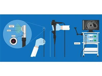 Endoskooppinen ultraääni (EUS) - Piilotettujen patologioiden paljastaminen