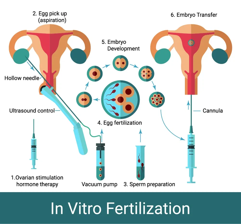 Erikokoisten munien hakuneulojen tehokkuus IVF -menettelyissä